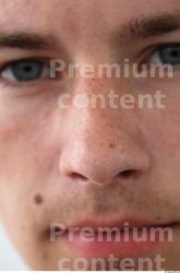 Nose Man White Birthmarks Athletic